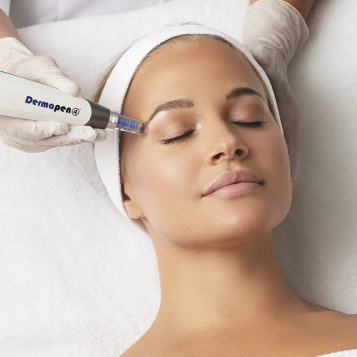 Micro-needling result