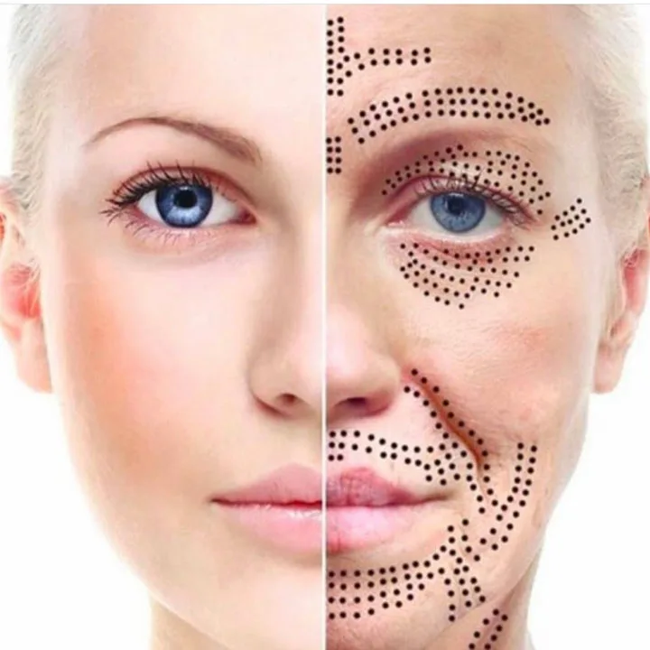 Plasma lift treatment